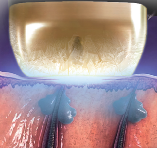 ICE Plus cooling handpiece over skin