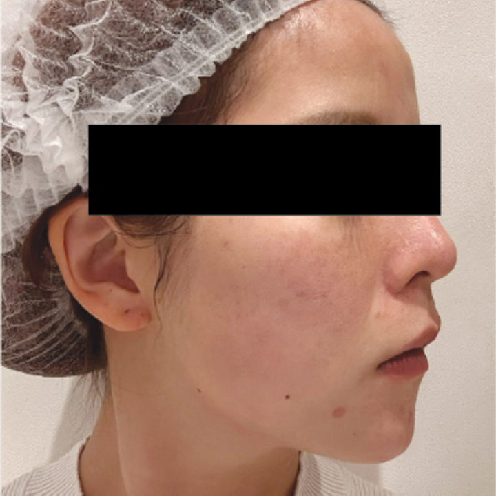 Titanium Lifting real case side profile after first treatment