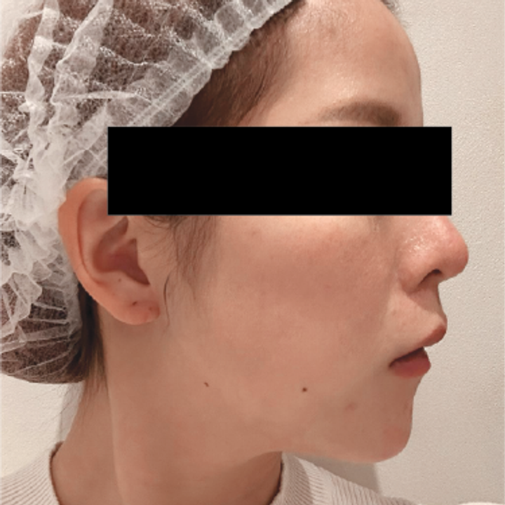 Titanium Lifting real case side profile before treatment