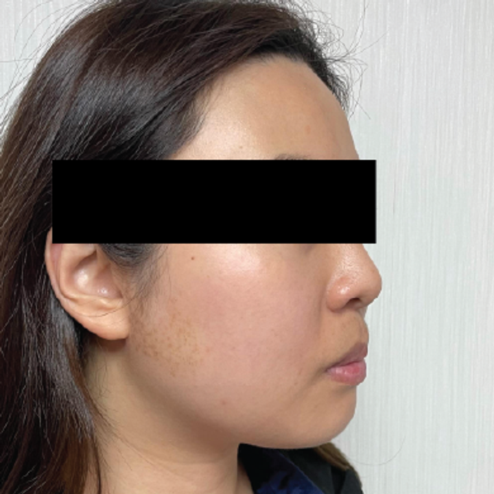 Titanium Lifting real case profile after second treatment
